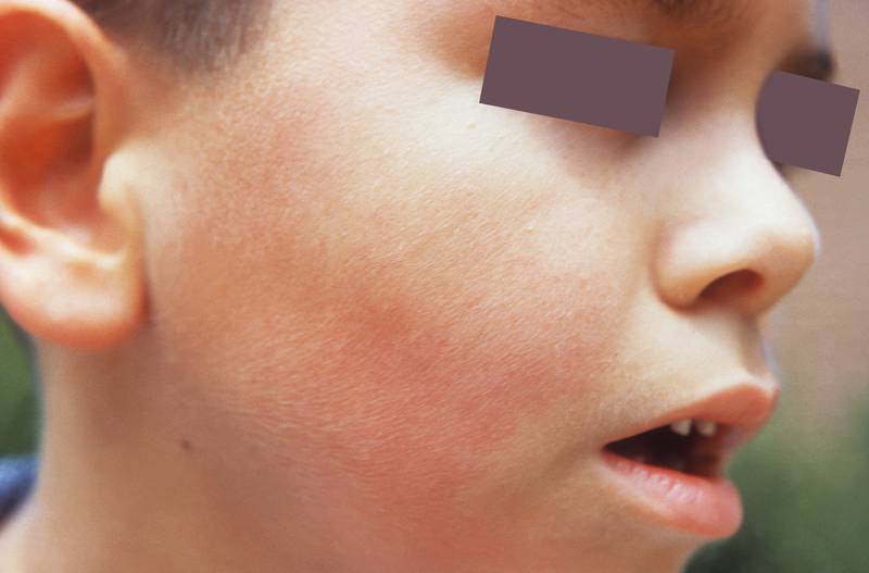 A child with a parvovirus B19 rash.